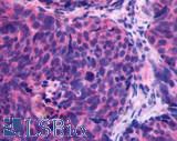 CXCR4 Antibody - Lung, small cell carcinoma