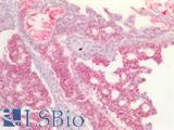 DNMT / DNMT1 Antibody - Human Ovary Carcinoma: Formalin-Fixed, Paraffin-Embedded (FFPE)