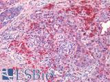 EPHB2 / EPH Receptor B2 Antibody - Human Skin Carcinoma: Formalin-Fixed, Paraffin-Embedded (FFPE)