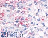 ESRRG / ERR Gamma Antibody - Breast carcinoma