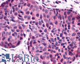 F2RL1 / PAR2 Antibody - Breast, Carcinoma