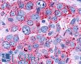 FAK / Focal Adhesion Kinase Antibody - Lung, non small cell carcinoma
