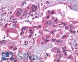 FP / PTGFR Antibody - Breast, Carcinoma