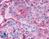 FZD4 / Frizzled 4 Antibody - Breast, Carcinoma