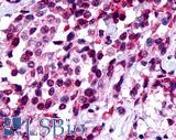 FZD8 / Frizzled 8 Antibody - Breast, Carcinoma