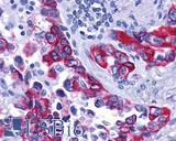 GPBAR1 / TGR5 Antibody - Lung, Non Small-Cell Carcinoma