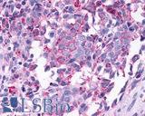 GPBAR1 / TGR5 Antibody - Breast, Carcinoma