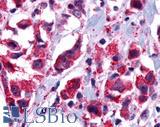 GPCR6 / GPR101 Antibody - Breast, carcinoma