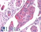 GPER1 / GPR30 Antibody - Breast, adenocarcinoma
