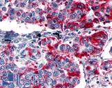 GPER1 / GPR30 Antibody - Anti-GPER1 / GPR30 antibody IHC of human Lung, Non-Small Cell Carcinoma. Immunohistochemistry of formalin-fixed, paraffin-embedded tissue after heat-induced antigen retrieval.