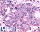 GPR150 Antibody - Colon, Carcinoma
