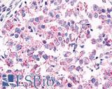 GPR26 Antibody - Breast, Carcinoma