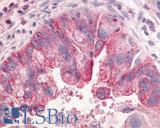 GPR31 Antibody - Lung, adenocarcinoma
