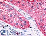 GPR32 Antibody - Lung, non small cell carcinoma