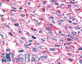 GPR35 Antibody - Lung, non small cell carcinoma