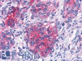 GPR44 / CRTH2 Antibody - Lung, small cell carcinoma