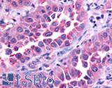 GPR45 Antibody - Lung, non small cell carcinoma