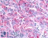 GPR45 Antibody - Lung, non small cell carcinoma