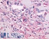 GPR55 Antibody - Pancreas, Adenocarcinoma