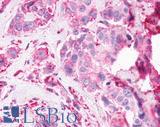 GPR61 Antibody - Breast, Carcinoma