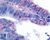 GPR63 Antibody - Colon, Carcinoma