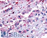 GPR65 / TDAG8 Antibody - Pancreas, carcinoma