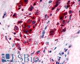 GPR89A Antibody - Breast, Carcinoma