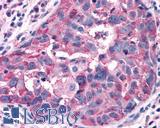GPRC5A / RAI3 Antibody - Breast carcinoma