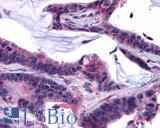 GPRC5C Antibody - Colon, Carcinoma