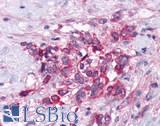 GPRC6A Antibody - Breast, carcinoma