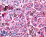 GRM8 / MGLUR8 Antibody - Anti-GRM8 / MGLUR8 antibody IHC of human Skin, Melanoma. Immunohistochemistry of formalin-fixed, paraffin-embedded tissue after heat-induced antigen retrieval.