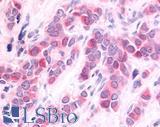 HUNK / B19 Antibody - Breast carcinoma