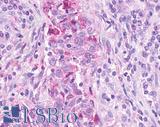LPAR2 / EDG4 Antibody - Breast, Carcinoma