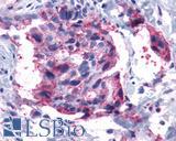 LTB4R2 / BLT2 Antibody - Breast, carcinoma