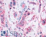 MAS1 / MAS Antibody - Breast carcinoma