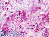 MLNR/GPR38/Motilin Receptor Antibody - Lung, non small-cell carcinoma
