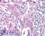 NEK6 Antibody - Breast carcinoma