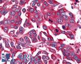 NEK7 Antibody - Colon carcinoma