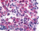 NEK9 Antibody - Non-Hodgkin's lymphoma