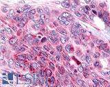 NEK9 Antibody - Colon, Carcinoma