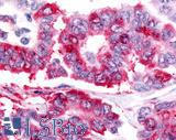 Nor-1 / NR4A3 Antibody - Lung, Non Small-Cell Carcinoma
