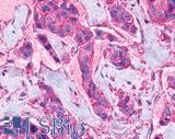 NPY4R / PPYR1 Antibody - Breast, carcinoma