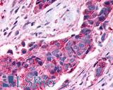 NPY4R / PPYR1 Antibody - Breast, carcinoma