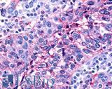 NR0B2 Antibody - Ovary, carcinoma
