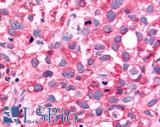 NR5A2 / LRH-1 Antibody - Breast, Carcinoma