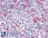 OR10R2 Antibody - Ovary, carcinoma