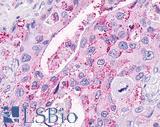 OXER1 Antibody - Pancreas, carcinoma