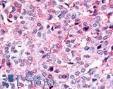 PAK6 Antibody - Breast, carcinoma
