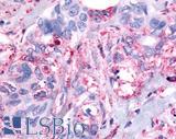PAK6 Antibody - Colon, Carcinoma