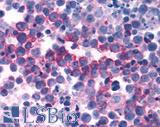 PKD3 / PRKD3 Antibody - Non-Hodgkin's lymphoma